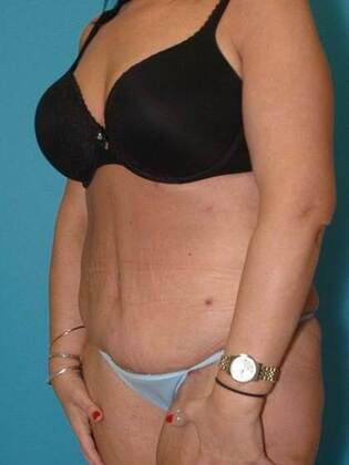 After Image: Abdominoplasty: Case4 - left-front-oblique