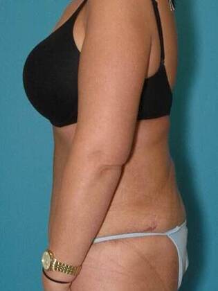 After Image: Abdominoplasty: Case4 - left-side