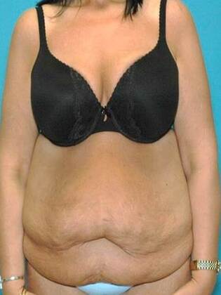 Before Image: Abdominoplasty: Case4 - front
