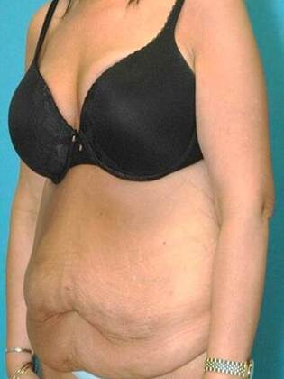 Before Image: Abdominoplasty: Case4 - left-front-oblique