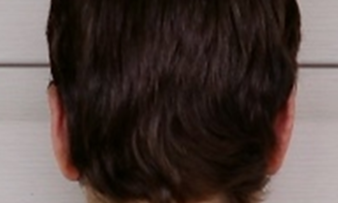 After Image: Otoplasty: Case 4 - back