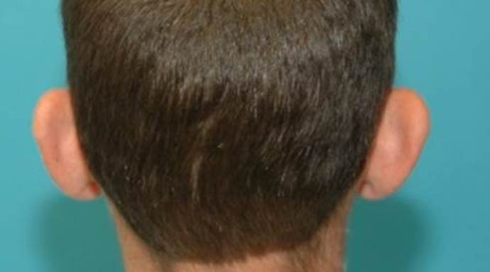 Before Image: Otoplasty: Case 4 - back