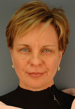 After Image: Eye Lift (Blepharoplasty): Case 4 - front
