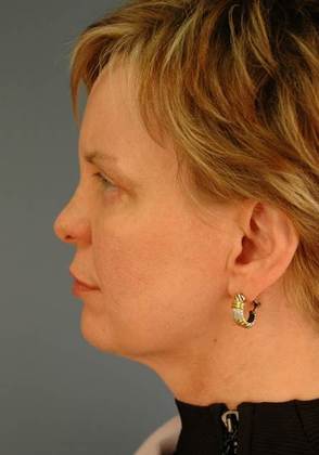 After Image: Eye Lift (Blepharoplasty): Case 4 - left-side