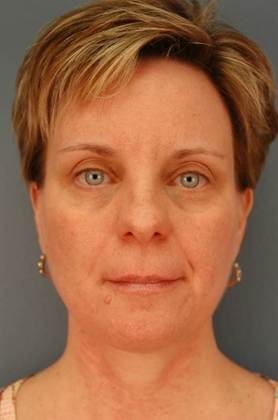 Before Image: Eye Lift (Blepharoplasty): Case 4 - front
