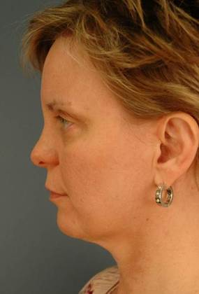 Before Image: Eye Lift (Blepharoplasty): Case 4 - left-side