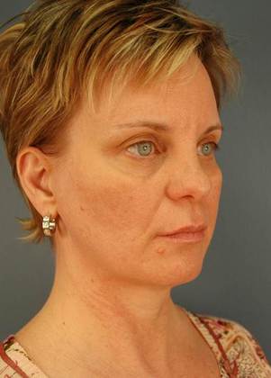 Before Image: Eye Lift (Blepharoplasty): Case 4 - right-front-oblique
