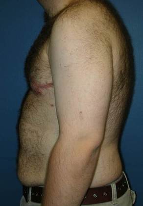After Image: Gynecomastia: Case 4 - left-side