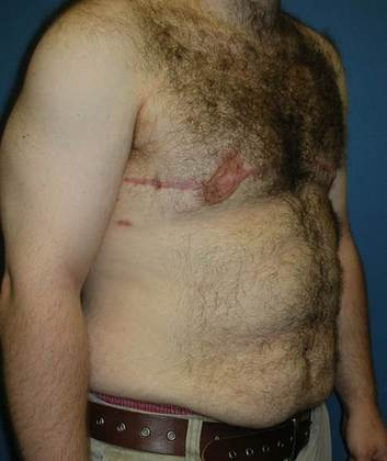 After Image: Gynecomastia: Case 4 - right-front-oblique