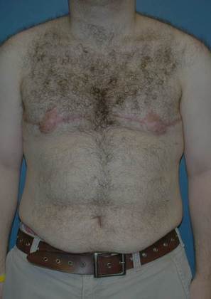 After Image: Gynecomastia: Case 4 - front