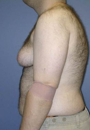 Before Image: Gynecomastia: Case 4 - left-side