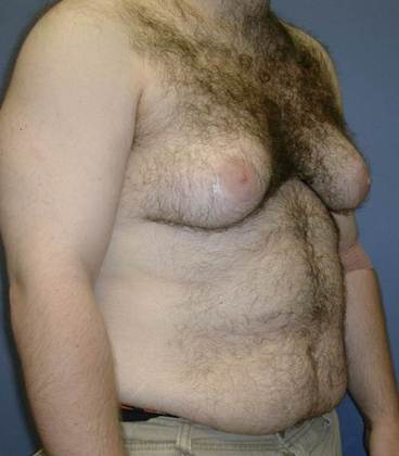 Before Image: Gynecomastia: Case 4 - right-front-oblique