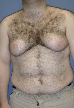 Before Image: Gynecomastia: Case 4 - front