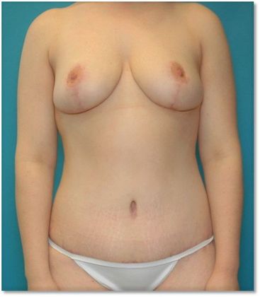 After Image: Breast Lift: Case 4 - front