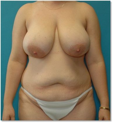 Before Image: Breast Lift: Case 4 - front