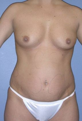 Before Image: Liposuction: Case 4 - front