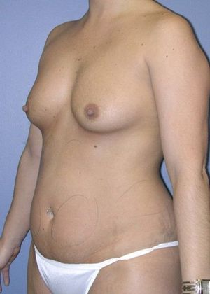 Before Image: Liposuction: Case 4 - left-front-oblique