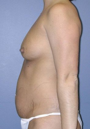 Before Image: Liposuction: Case 4 - left-side