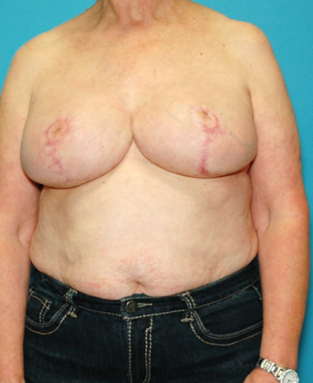 After Image: Breast Reduction: Case 4 - front