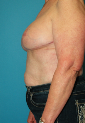After Image: Breast Reduction: Case 4 - left-side