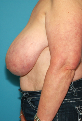 Before Image: Breast Reduction: Case 4 - left-side