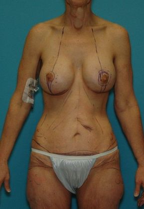After Image: Arm Lift: Case 4 - front