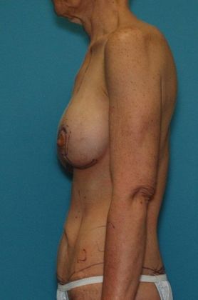 After Image: Arm Lift: Case 4 - left-side