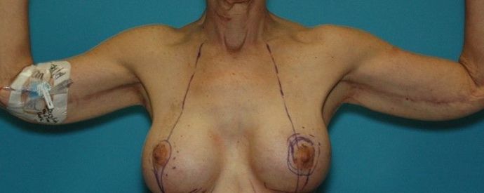After Image: Arm Lift: Case 4 - front