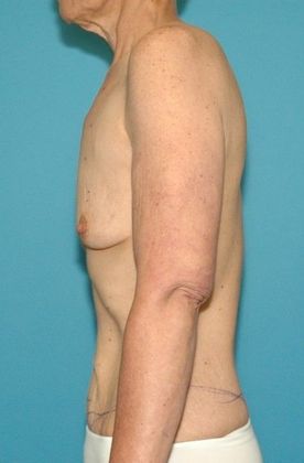 Before Image: Arm Lift: Case 4 - left-side