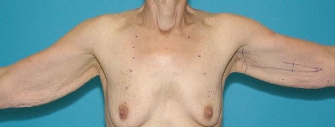 Before Image: Arm Lift: Case 4 - front