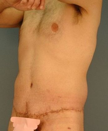 After Image: Body Lifts: Case 4 - left-front-oblique