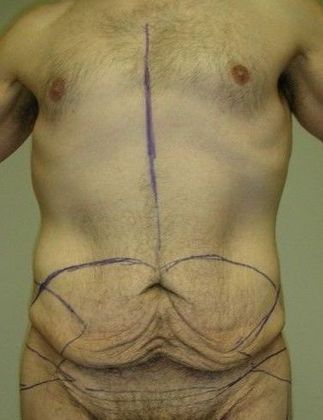 Before Image: Body Lifts: Case 4 - front