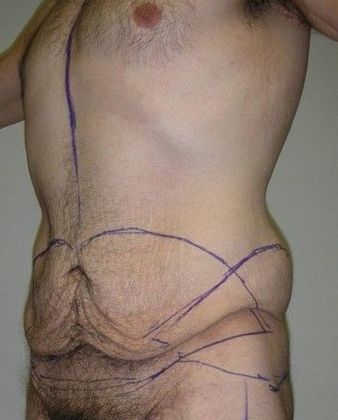 Before Image: Body Lifts: Case 4 - left-front-oblique