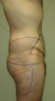 Before Image: Body Lifts: Case 4 - right-side