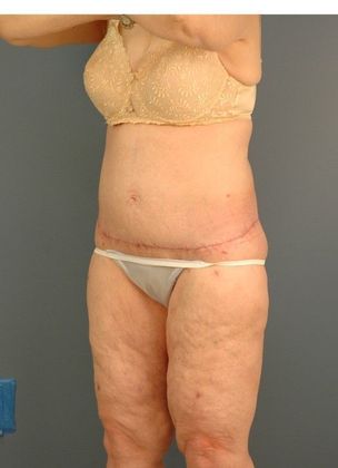 After Image: Thigh Lift: Case 4 - left-front-oblique