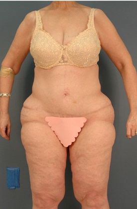 Before Image: Thigh Lift: Case 4 - front