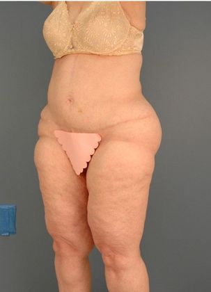 Before Image: Thigh Lift: Case 4 - left-front-oblique