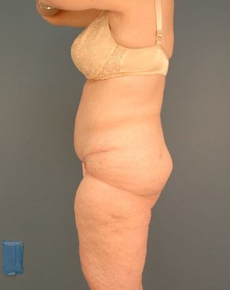 Before Image: Thigh Lift: Case 4 - left-side