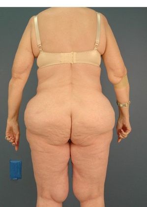 Before Image: Thigh Lift: Case 4 - back