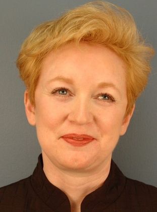 After Image: Brow Lift: Case 4 - front