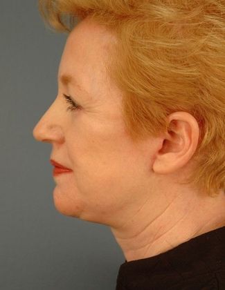 After Image: Brow Lift: Case 4 - left-side