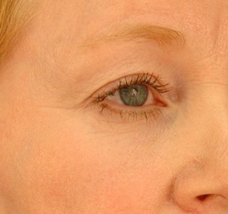 After Image: Brow Lift: Case 4 - right-front-oblique