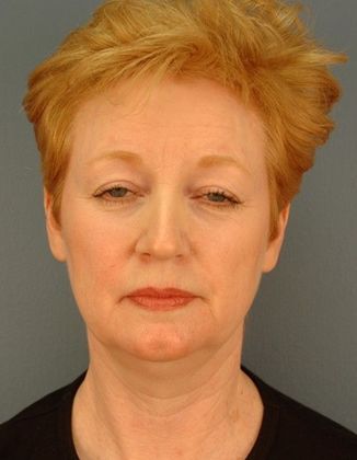 Before Image: Brow Lift: Case 4 - front