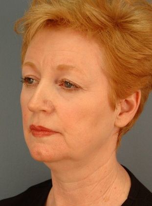 Before Image: Brow Lift: Case 4 - left-front-oblique