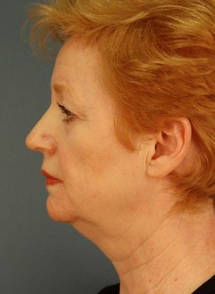 Before Image: Brow Lift: Case 4 - left-side