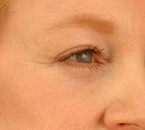 Before Image: Brow Lift: Case 4 - right-front-oblique