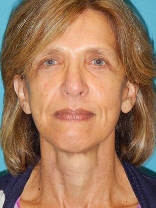 After Image: Face & Neck Lifts: Case 4