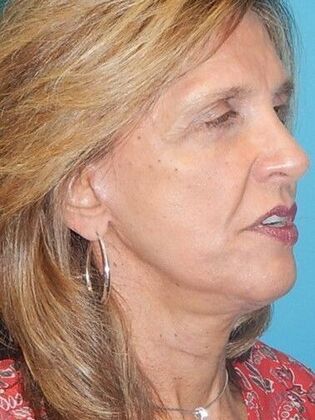 After Image: Face & Neck Lifts: Case 4 - right-front-oblique