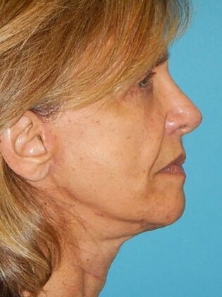 After Image: Face & Neck Lifts: Case 4 - right-side