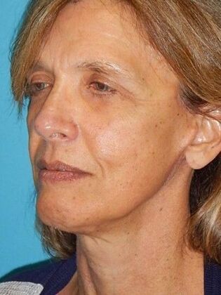 After Image: Face & Neck Lifts: Case 4 - left-front-oblique